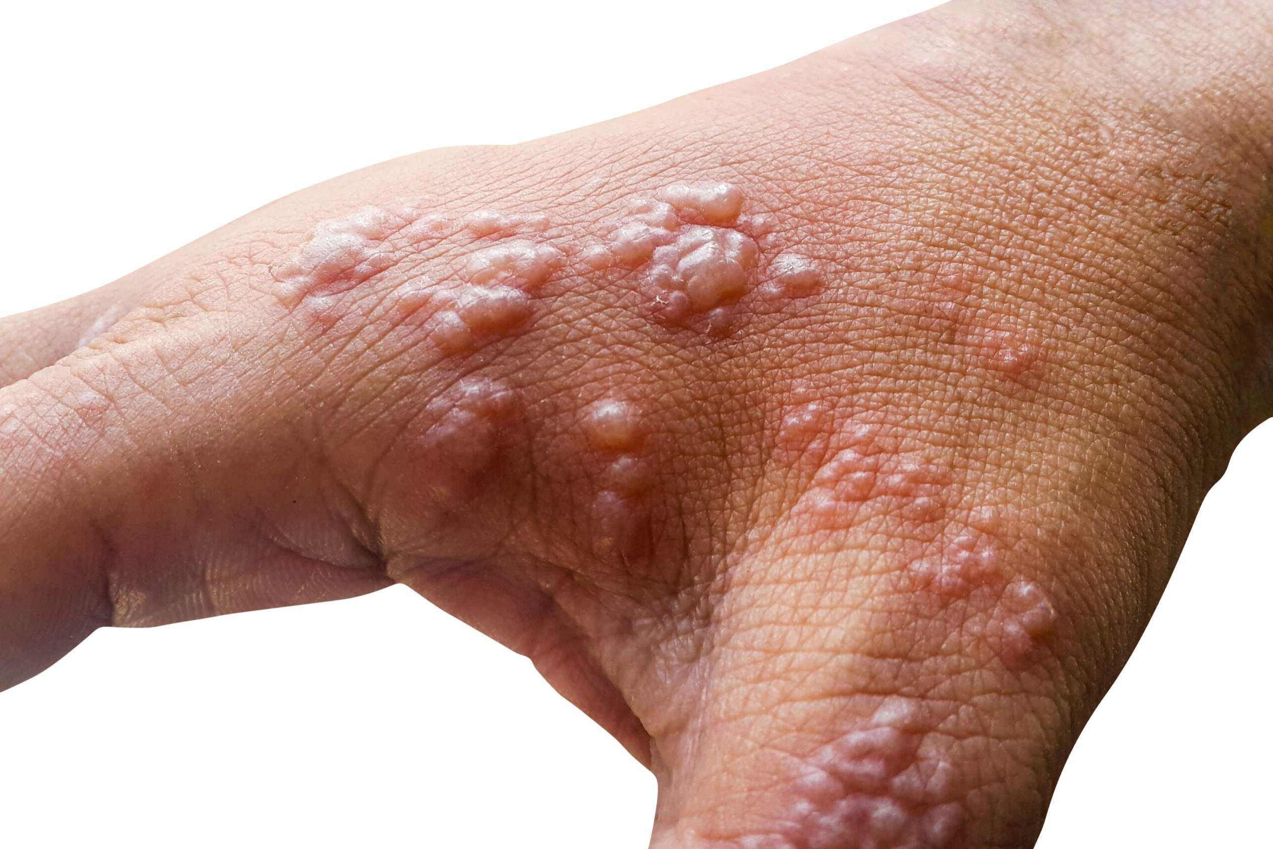 39-facts-about-pemphigoid